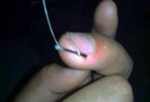 10斤多草鱼把手指伤了值得吗？这次疼入骨髓