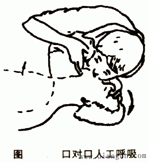 触电的急救