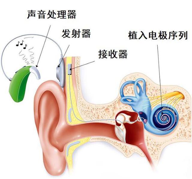 关于人工耳蜗植入磁铁简介