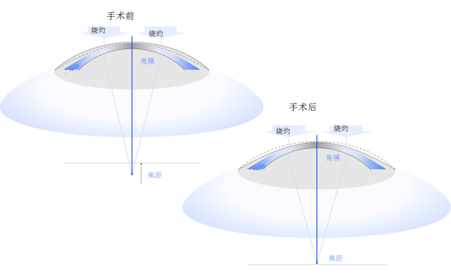 压电电机在准分子激光和飞秒激光矫正手术的应用