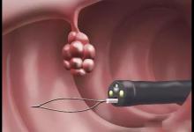 肠道里长息肉，上厕所时会有3个提示吗？需引起警惕，避免恶化