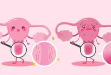 双腿是宫颈癌的“预警器”吗？若出现4种情况，建议及早检查