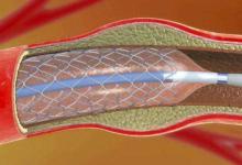 心脏支架手术是治病救人，还是“害人”？放了支架后能活几年？