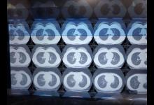 肺部CT检查需求“暴增”？专家教你如何自测肺部是否感染