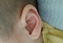 孩子身上有这5个“痣”，或是“好福气”的象征，看你家孩子有吗