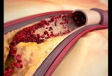 85岁大爷斑块消失，他让血管变“干净”的三个方法，值得我们借鉴