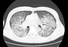 医生提醒：不停咳嗽，先别乱吃药！出现这些症状，及早检查