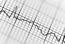心电图能穿内衣吗