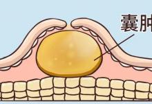 医生提醒：大多数囊肿无需处理，但若囊肿出现在5个地方，需警惕