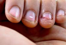 男孩啃秃10个指甲引发骨髓炎长期啃咬指甲的后果都哪些？