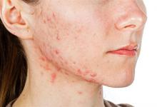 花粉过敏导致脸上起红疙瘩该怎么办