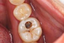 男孩蛀牙疼如何改善