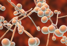 得了霉菌性阴炎一辈子完了吗