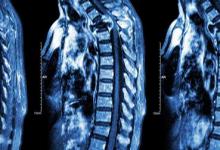 脊髓空洞的病因有哪些？治疗方法有哪些？