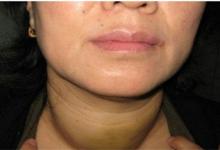 ​甲亢是什么原因造成的甲亢是怎么回事