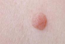 身上有疣是感染了HPV么身上有疣和HPV有关吗