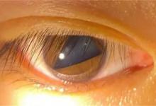 瞳孔突然变成三角形是什么原因造成的