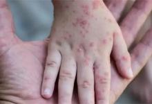 ​猴痘的皮疹最先出现的部位猴痘的皮疹特点有哪些