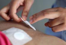 三伏贴贴上去火辣辣什么症状