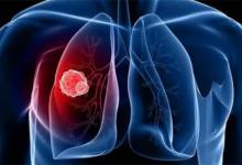 肺癌的早期症状有什么肺癌形成的病因是什么