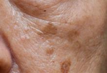 ​老年斑怎么引起的老年斑是指什么