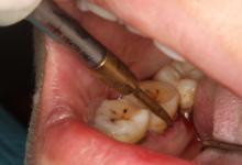 龈下刮治后更容易结石吗