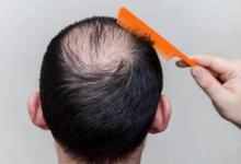年轻人脱发有哪些原因呢