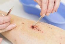 小创面伤口的“威力”为何这么大