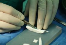 ​硅胶隆鼻有什么副作用吗硅胶隆鼻安全吗