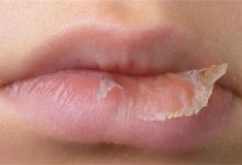 反复口腔溃疡嘴唇起皮是什么原因嘴唇起皮是什么原因