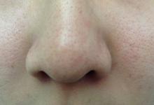 ​脸上的黑头是怎么来的脸上的黑头怎么处理