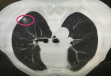 肺结节的症状有什么肺结节病因是什么