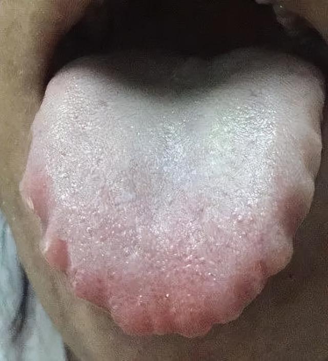 具体可以看下图,都是脾虚状态下的舌头.