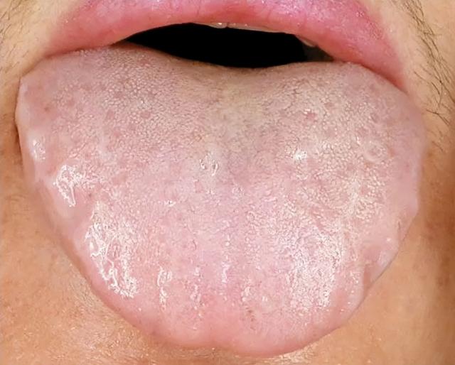 操心的人舌头有齿痕,这是身体求救的信号,3个方法帮你挽救_养生保健