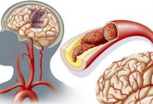 脑供血不足有哪些信号脑供血不足原因是什么